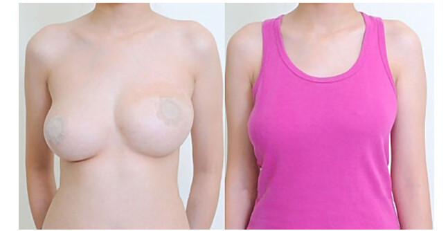 Ανόρθωση Στήθους με τα Αόρατα Αυτοκόλλητα Bare Lifts